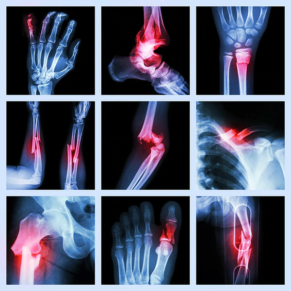 Fracture